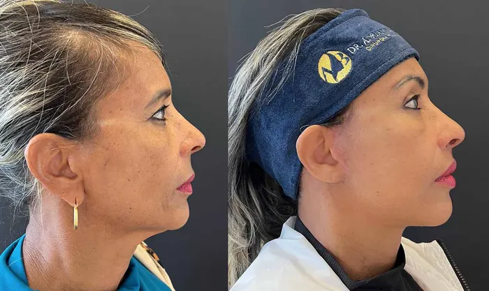 Antes e depois de rejuvenescimento facial com deep plane facelift