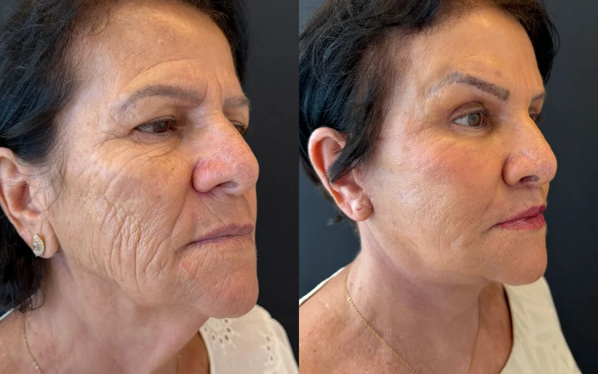 Antes e depois de deep plane facelift com laser de co2 – paciente do Dr. Adriano Borges em Brasília