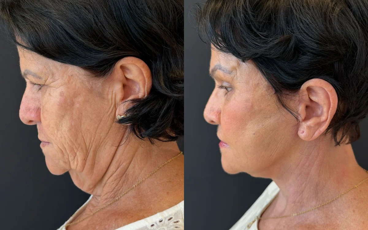 Antes e depois de deep plane facelift com laser de co2 – paciente do Dr. Adriano Borges em Brasília