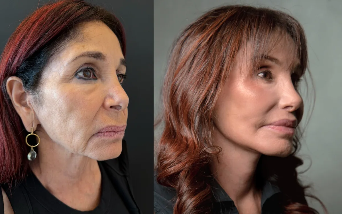 Antes e depois de deep plane facelift com rinoplastia e laser de co2 – paciente do Dr. Adriano Borges em Brasília