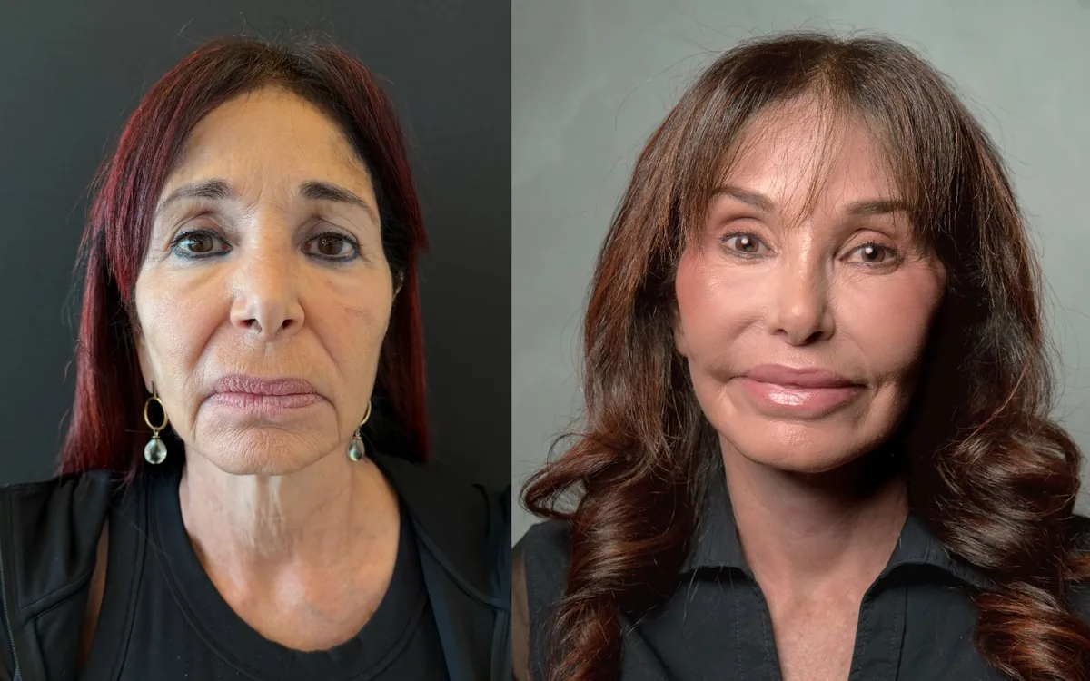 Antes e depois de deep plane facelift com rinoplastia e laser de co2 – paciente do Dr. Adriano Borges em Brasília