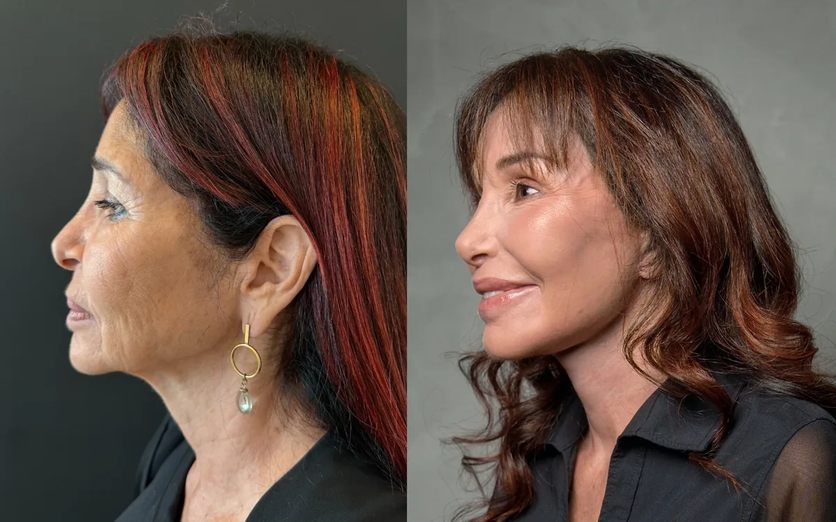 Antes e depois de deep plane facelift com rinoplastia e laser de co2 – paciente do Dr. Adriano Borges em Brasília