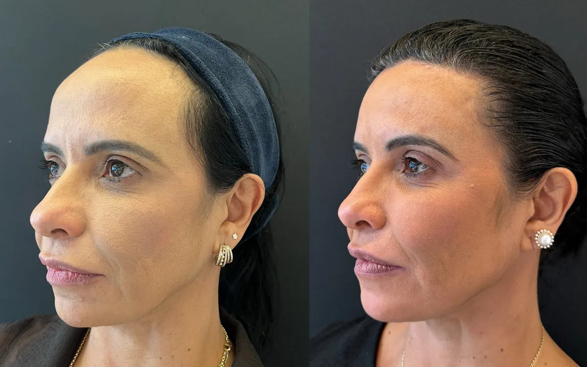 Antes e depois de frontoplastia – paciente do Dr. Adriano Borges em Brasília