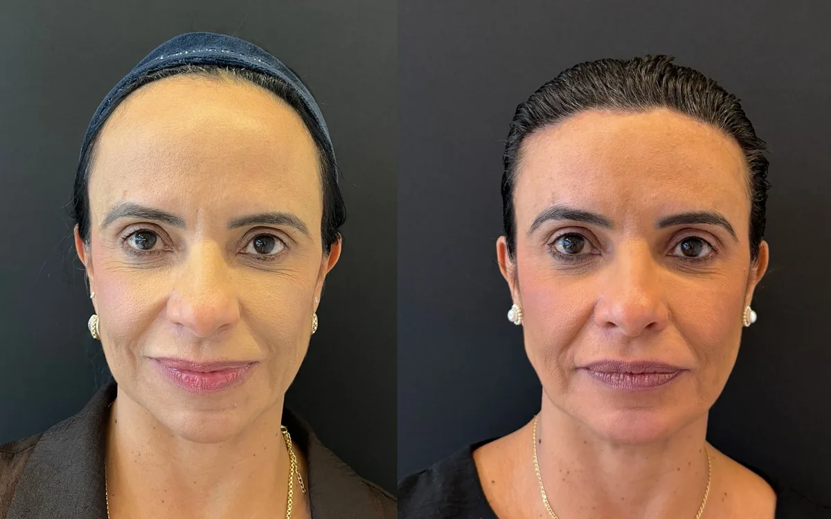Antes e depois de frontoplastia – paciente do Dr. Adriano Borges em Brasília