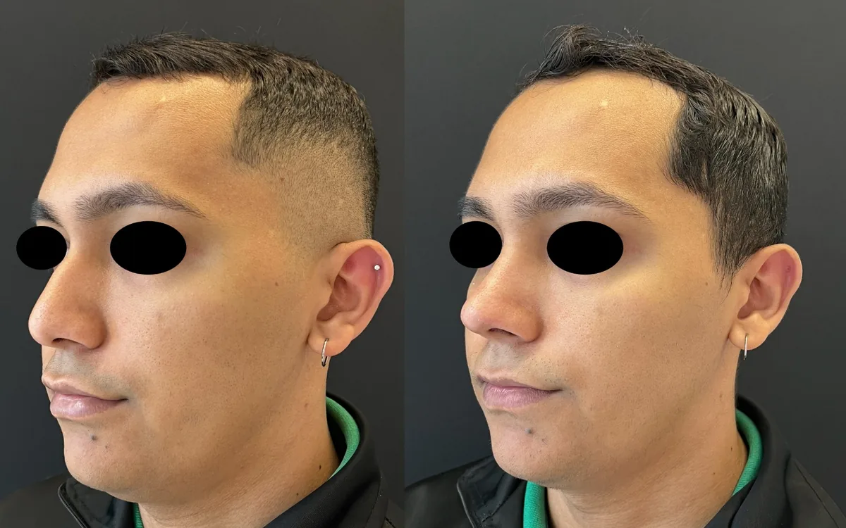 Antes e depois de rinoplastia masculina – paciente do Dr. Adriano Borges em Brasília