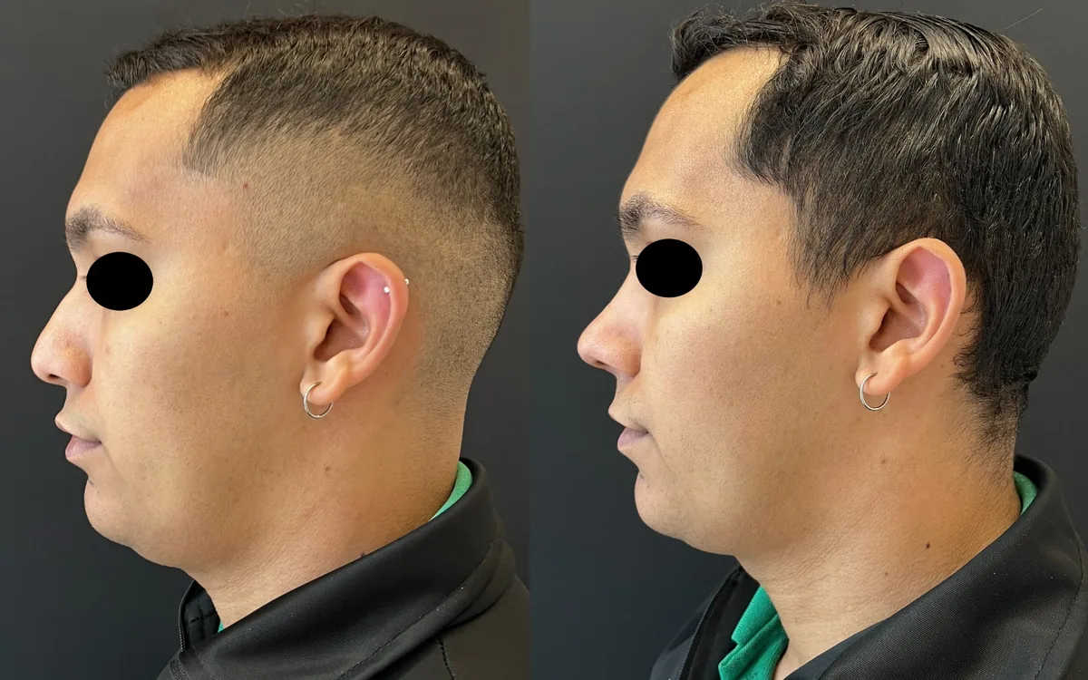 Antes e depois de rinoplastia masculina – paciente do Dr. Adriano Borges em Brasília