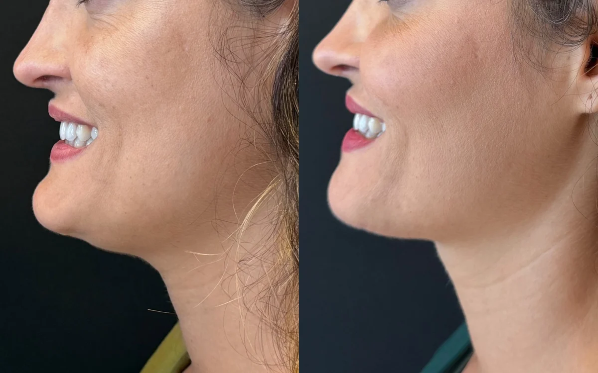 Antes e depois de mentoplastia com desgaste ósseo – paciente do Dr. Adriano Borges em Brasília