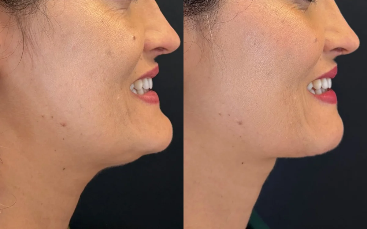Antes e depois de mentoplastia com desgaste ósseo – paciente do Dr. Adriano Borges em Brasília