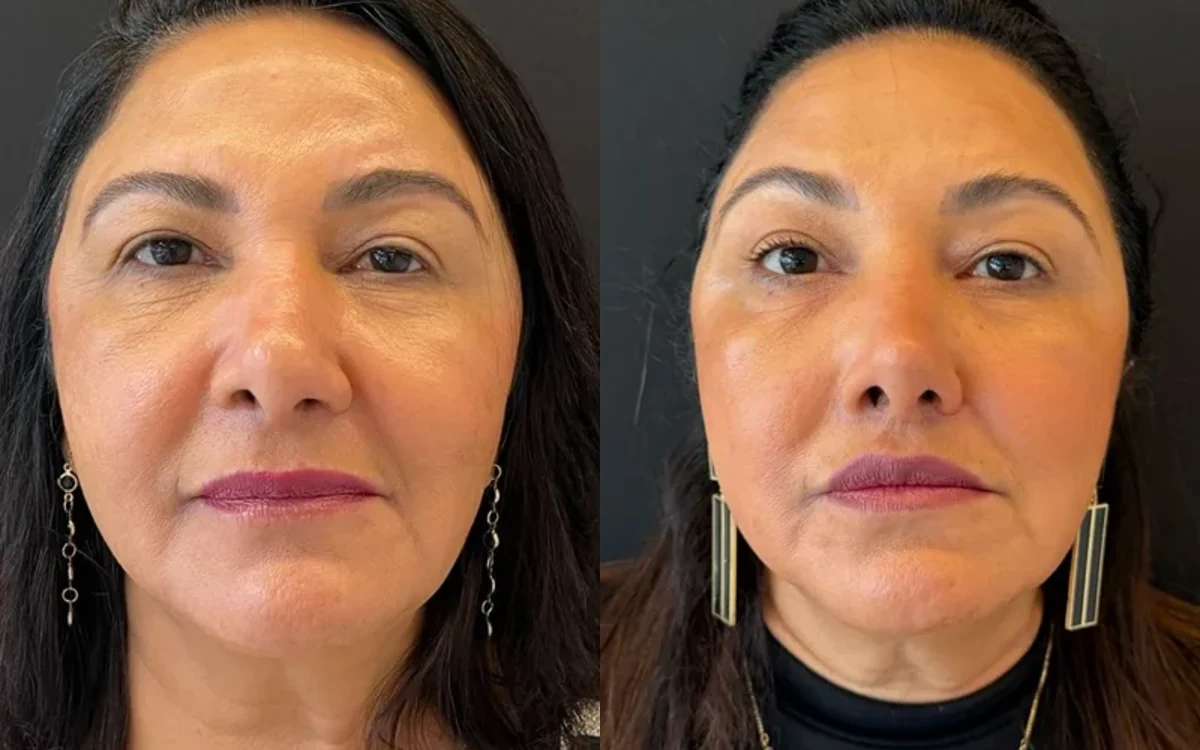 Antes e depois de rinoplastia feminina – paciente do Dr. Adriano Borges em Brasília