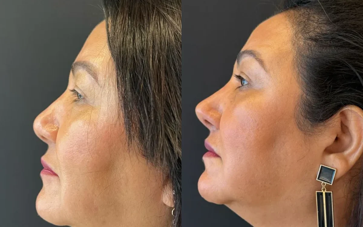 Antes e depois de rinoplastia feminina – paciente do Dr. Adriano Borges em Brasília